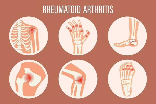 rheumatoid arthritis treatment