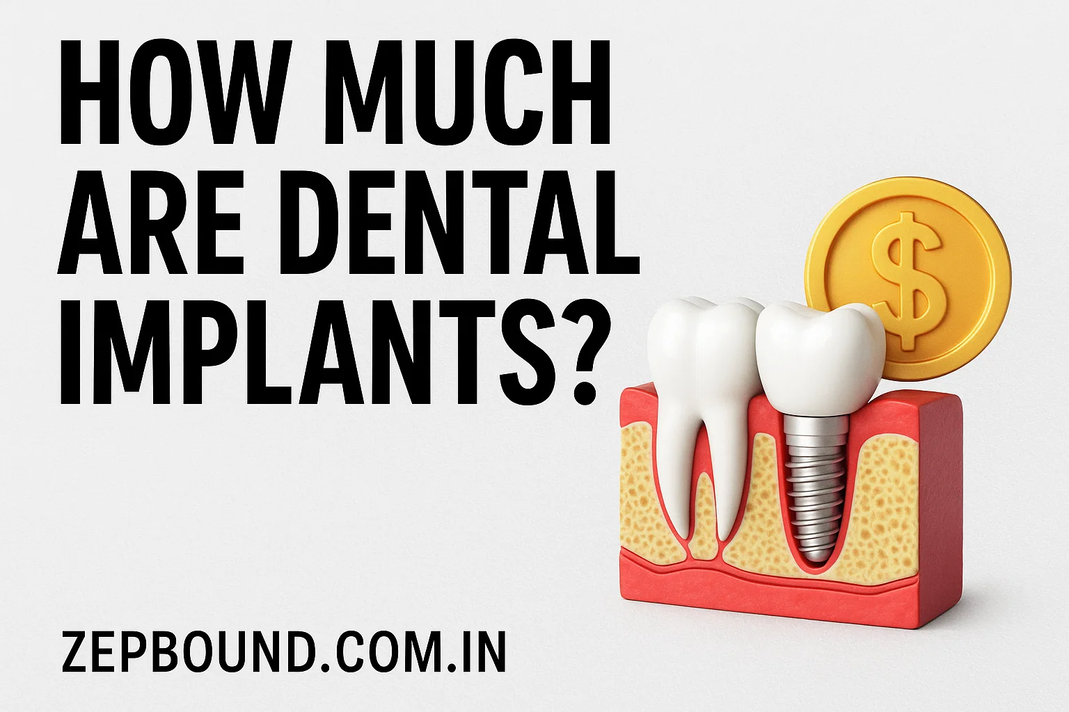 how much are dental implants