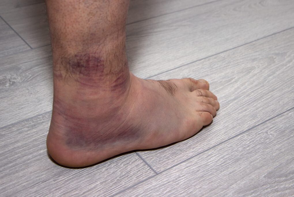 swollen ankle