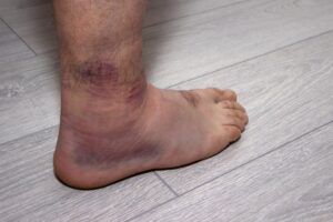 swollen ankle